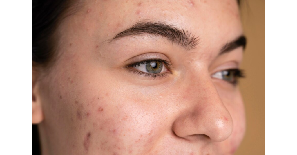 The Science Behind Dark Spots: A Simple Guide